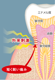 知覚過敏（術後4週間、12週間）