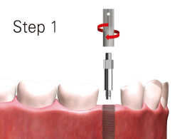 スマートペグをインプラント体に装着します