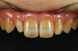 上顎左右２番の矮小歯の審美的改善を主訴に来院。