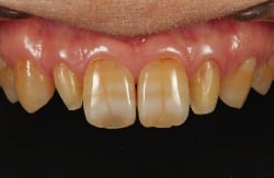 矮小歯のためラミネートベニア被覆範囲の新鮮面を出す程度で支台歯形成を完了。