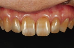 ラミネートベニア装着1ヶ月後。左右２番の形態と色調が改善され前歯部全体のバランスが整った。