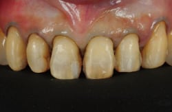 モックアップによる術前の診断から可及的エナメル質保存を心がけ無麻酔で支台歯形成。