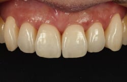ラミネートベニア装着後1か月の口腔内写真。ラミネートベニアの良好な適合により辺縁歯肉の回復も見てとれる。