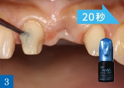 窩洞・支台歯の前処理