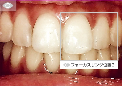 口腔全域撮影（フォーカスリング位置3）