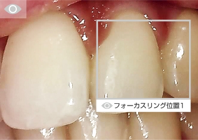 歯列撮影（フォーカスリング位置2）