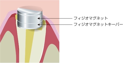 フィジオマグネットとフィジオマグネットキーパー