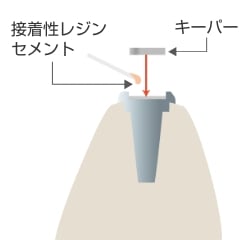 研磨後、キーパーを接着性レジンセメントにて接着