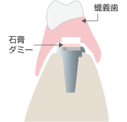 作業模型に石こうダミーを取りつけ、ろう義歯を製作