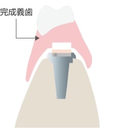 通法に従い義歯を重合・研磨