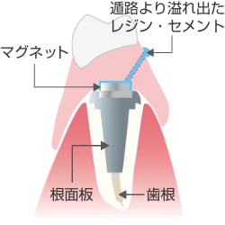 即時重合レジンまたは接着性レジンセメントによるマグネットの取り付け