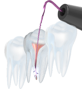 モリタ】Root ZX3 - 歯科用根管長測定器（一般的電気手術器）｜歯科 