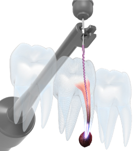 モリタ】Root ZX3 - 歯科用根管長測定器（一般的電気手術器）｜歯科 