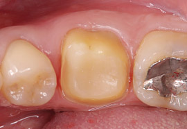 支台歯の写真