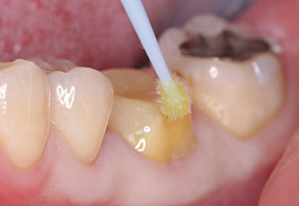 支台歯の処理の写真