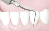 歯肉縁下の歯石除去の使用例