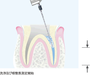 洗浄及び根管長測定開始イメージ