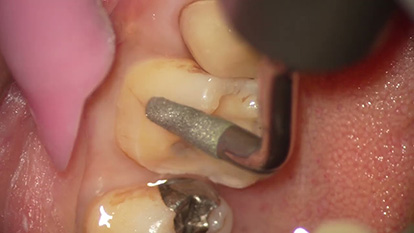 下顎臼歯部①内壁・窩底の形成・仕上げ(S41)