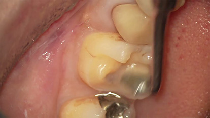 下顎臼歯部②遠心面の形成・仕上げ(S42)