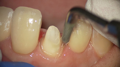 支台歯の形成・仕上げ(S41)