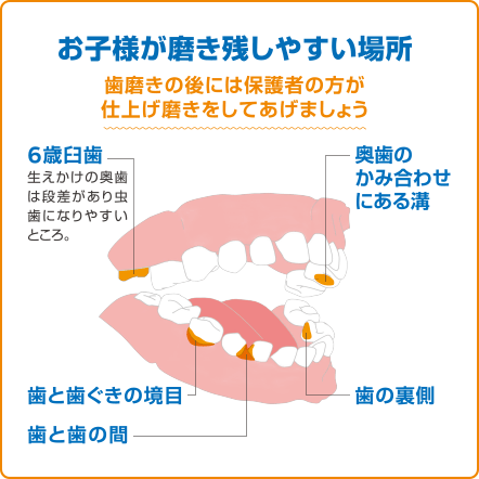 [お子様が磨き残しやすい場所]歯磨きの後には保護者の方が仕上げ磨きをしてあげましょう　6歳臼歯／歯と歯ぐきの境目／歯と歯の間／奥歯のかみ合わせにある溝／歯の裏側