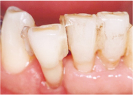 下顎側切歯保存不可能