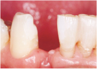 抜去歯根を切断後