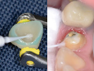支台歯レジン面にスーパーボンド PZプライマーを塗布、支台歯象牙質にティースプライマーを塗布時のイメージ