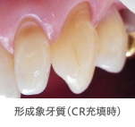 形成象牙質（CR充填時）のイメージ