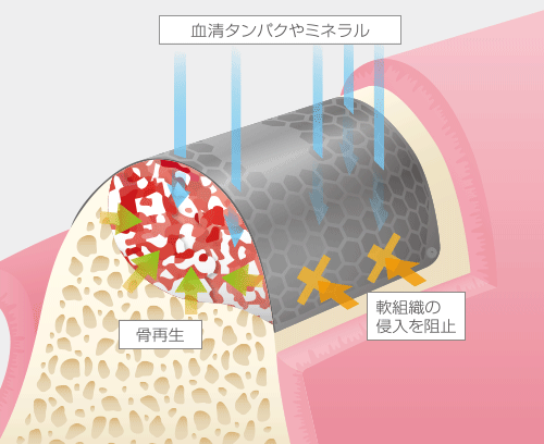 Tiハニカムメンブレン利用時の骨再生イメージ