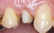 歯冠部への築盛、光照射※11 最終硬化・形成