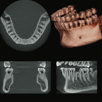 Dental Arch FOV Φ80×H50mm