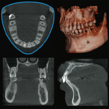Dental Arch FOV Dental Arch FOV (R100×H80mm)