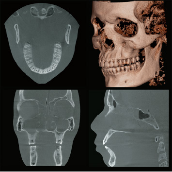 Dental Arch FOV Φ150×H140mm