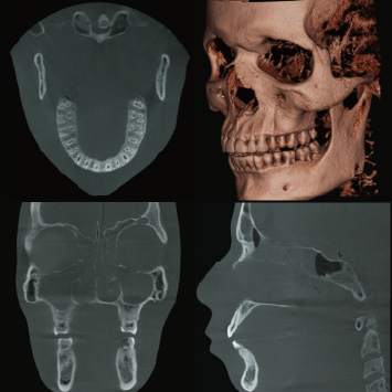 Dental Arch FOV Φ150×H140mm