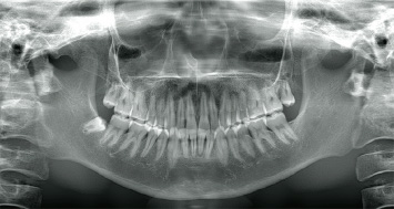 顎骨パノラマ