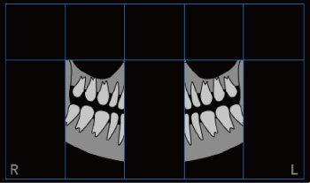 部分パノラマ（歯列）撮影