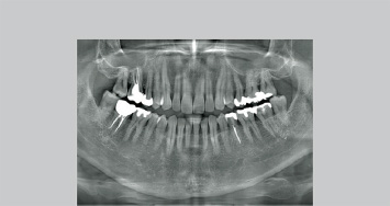 前歯部から大臼歯部までの撮影