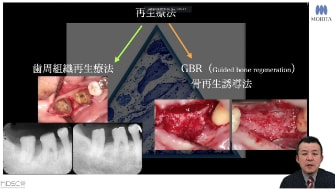 [サムネイル] [後編]歯周組織再生療法・GBRを楽しく学ぼう ～再生療法を成功に導く5つのポイント～