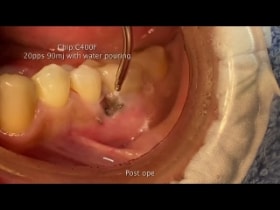 [サムネイル] 患者さん向け説明動画 | フロー・サイナスケア - 鼻うがい洗浄液 -