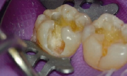 う蝕象牙質除去と窩洞形成（頬側面） 