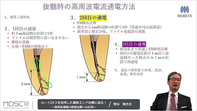 抜髄と穿通不可能な根尖性歯周炎への応用 | 菅谷勉 先生