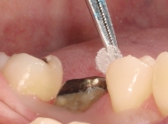 残存歯質をティースプライマーで前処理