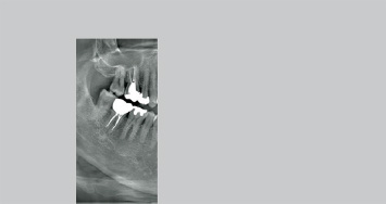 右側大臼歯部の撮影